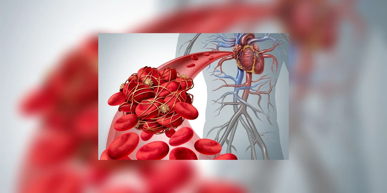 Médicos alertam para o aumento de coágulos em pacientes com Covid-19