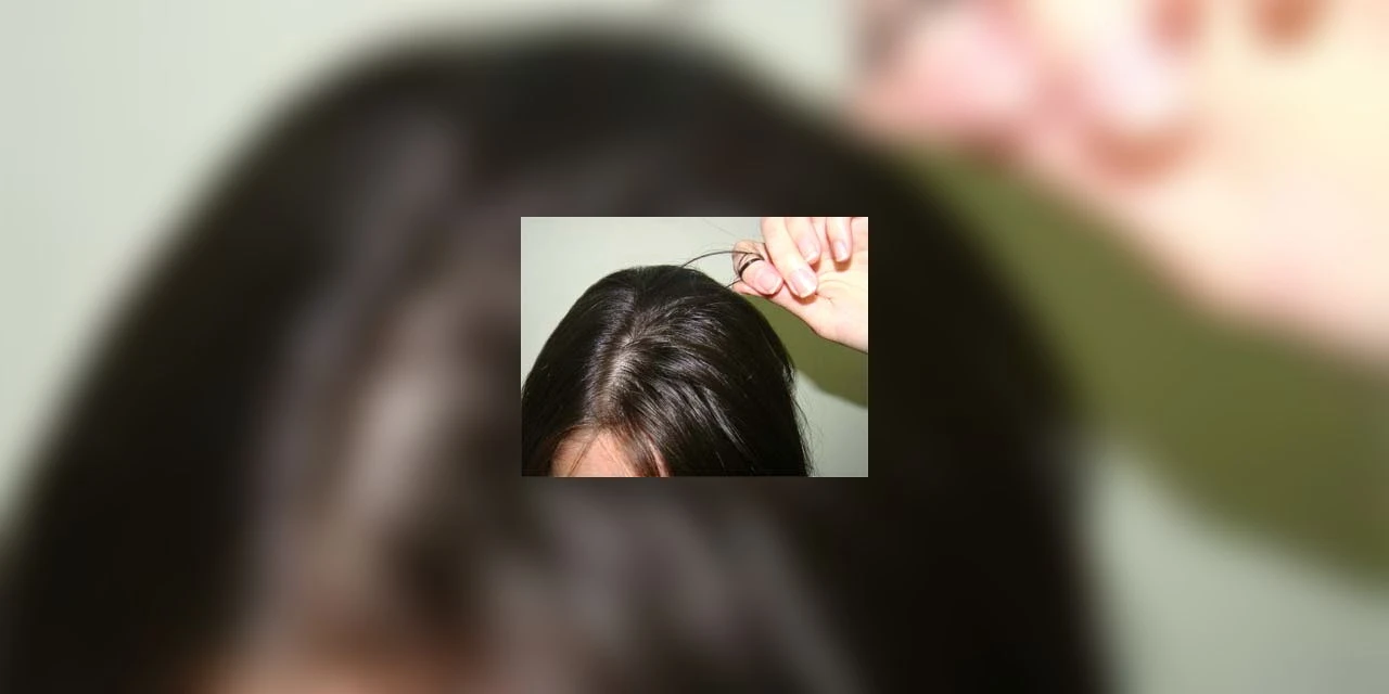 Tricotilomania: Jovem de 17 anos remove bola de cabelo de 48 cm do estômago