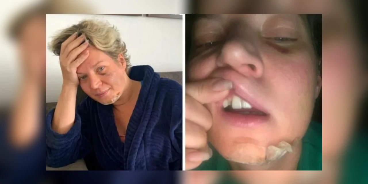 Joice Hasselmann aparece com machucados no rosto e no corpo e afirma ter sofrido atentado