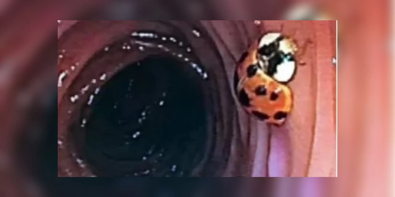 Homem faz colonoscopia e descobre joaninha vivendo em seu intestino