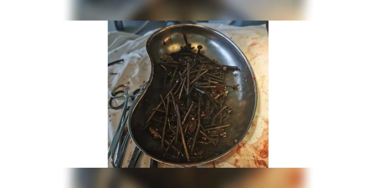 Médicos tiram um quilo de pregos do estômago de paciente; entenda o que aconteceu