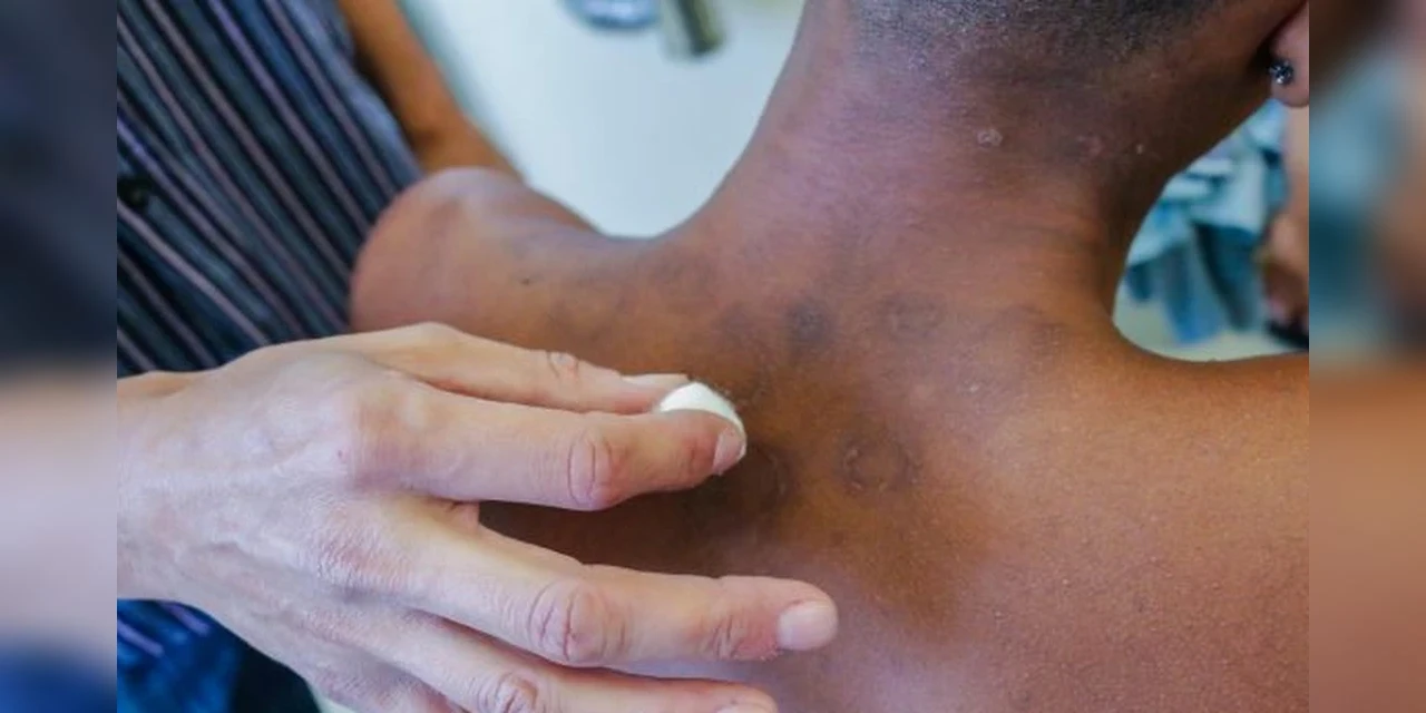 Janeiro Roxo alerta para a conscientização sobre a hanseníase