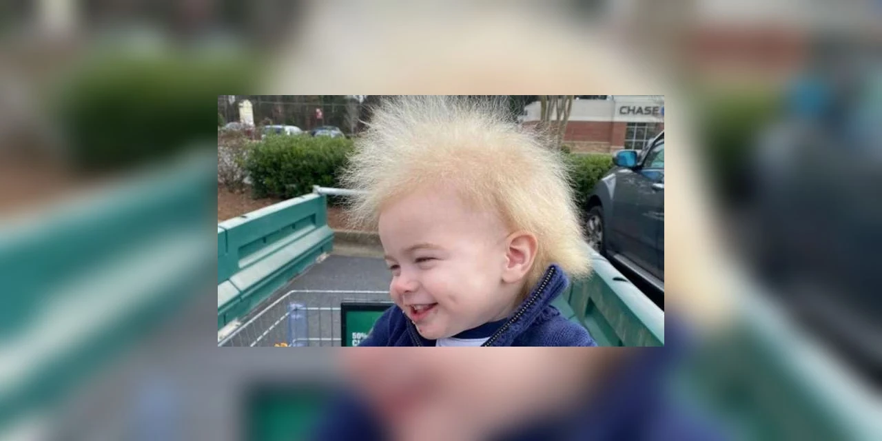 Síndrome rara do 'cabelo impenteável' faz menino de um ano viralizar na internet