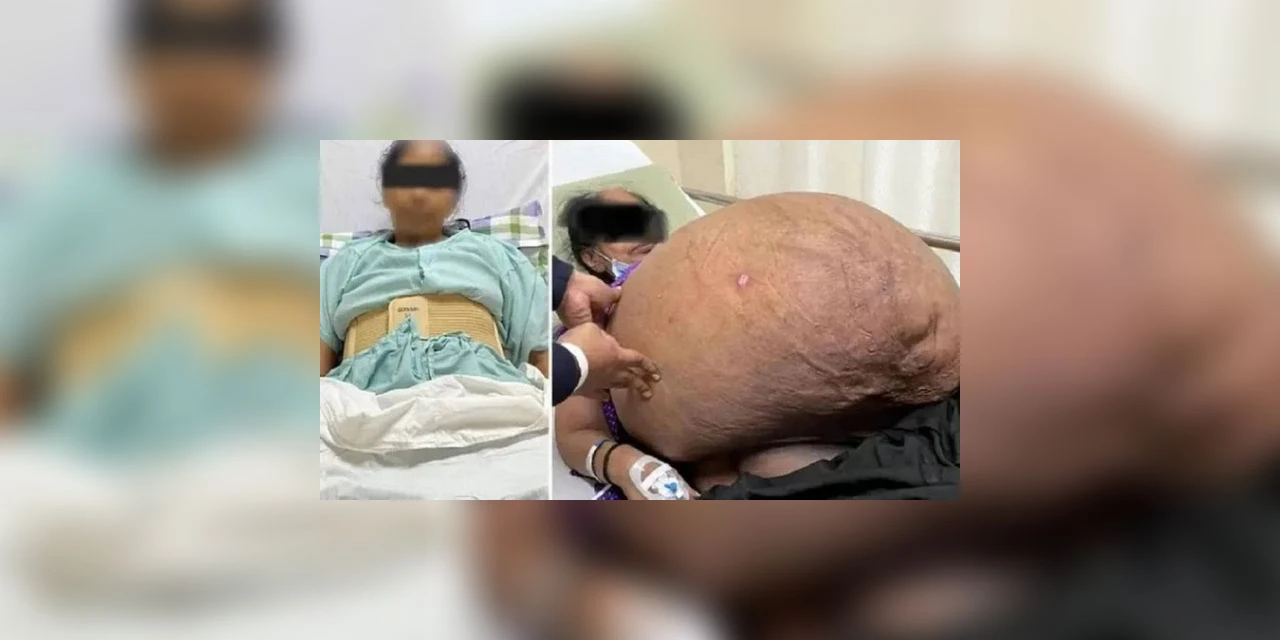 Após 18 anos, mulher tem tumor de 47 quilos removido do estômago