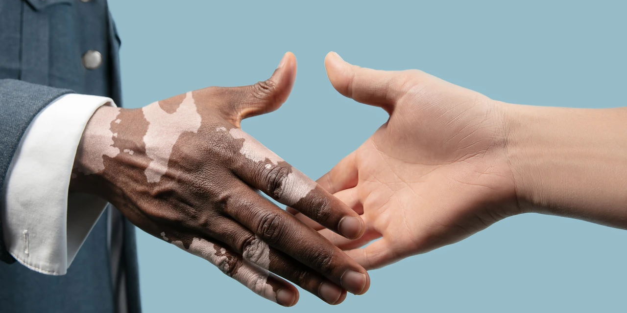 Cerca de 1 milhão de pessoas no Brasil têm Vitiligo