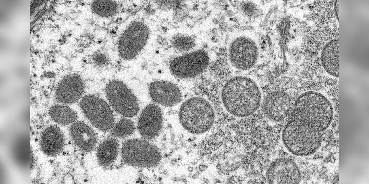 Brasil registra terceiro caso de varíola dos macacos