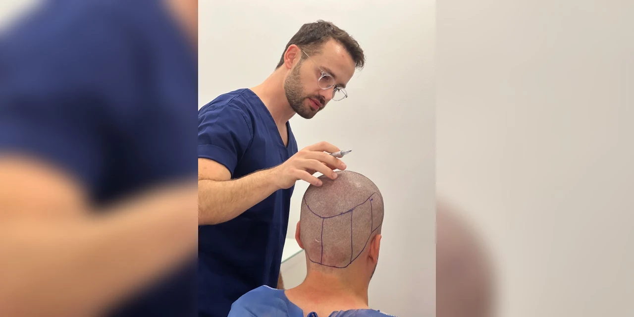FUE é o transplante capilar mais realizado entre os homens