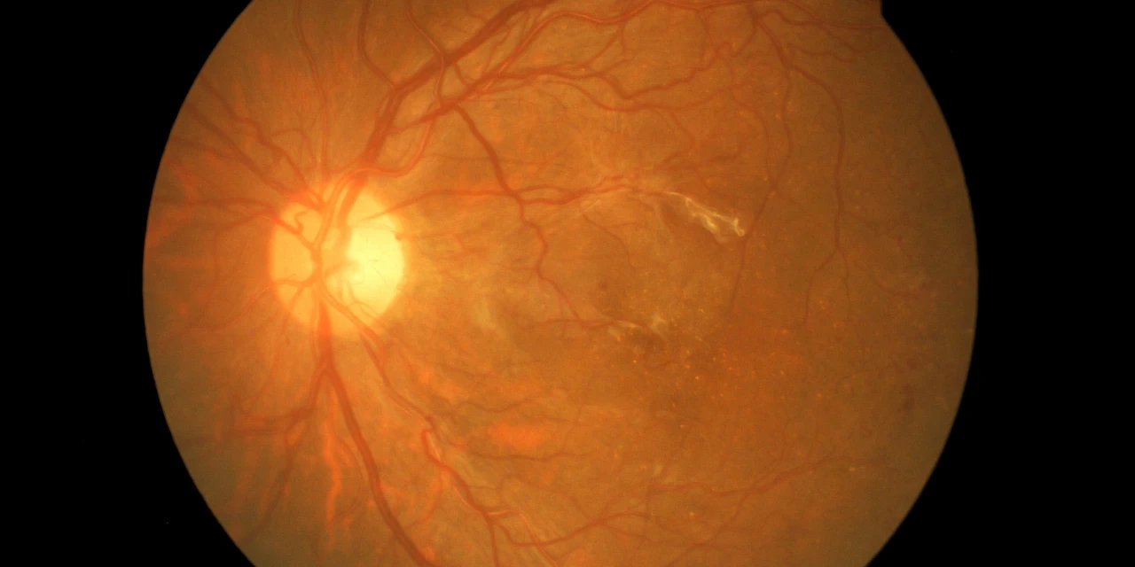 Descontrole das taxas de açúcar pode levar a retinopatia diabética