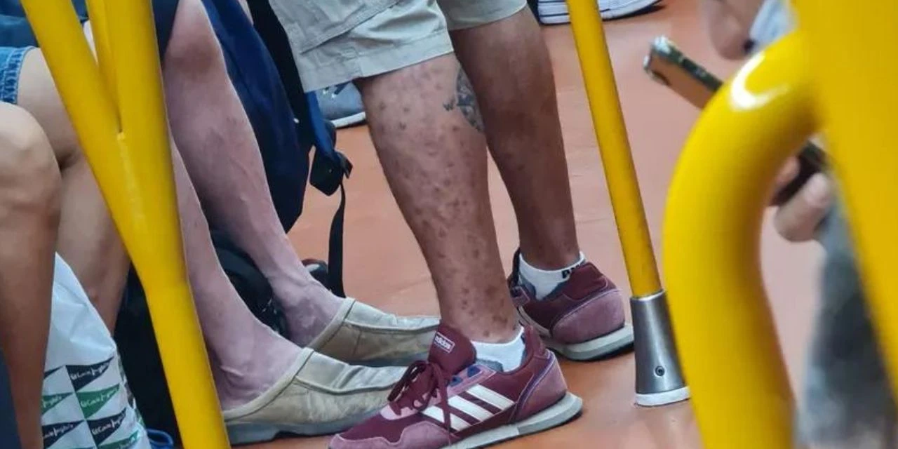 Médico flagra homem com varíola dos macacos no metrô: "Minha médica não me disse que eu tinha que ficar em casa"