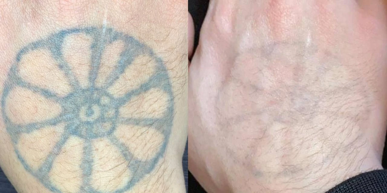 Especialista esclarece dúvidas sobre remoção de tatuagem