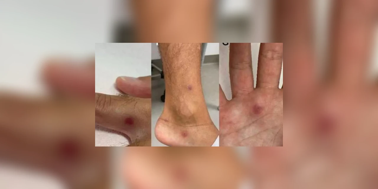 Homem é diagnosticado com HIV, Covid e varíola dos macacos ao mesmo tempo