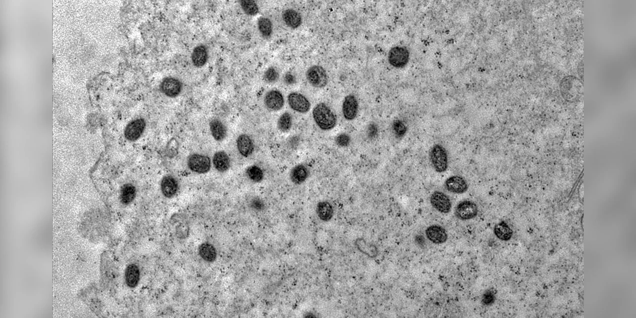 Pesquisa indica risco de monkeypox agravar infecção por HIV
