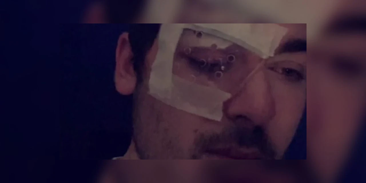 Jovem dorme com lentes de contato e tem olho devorado por parasita