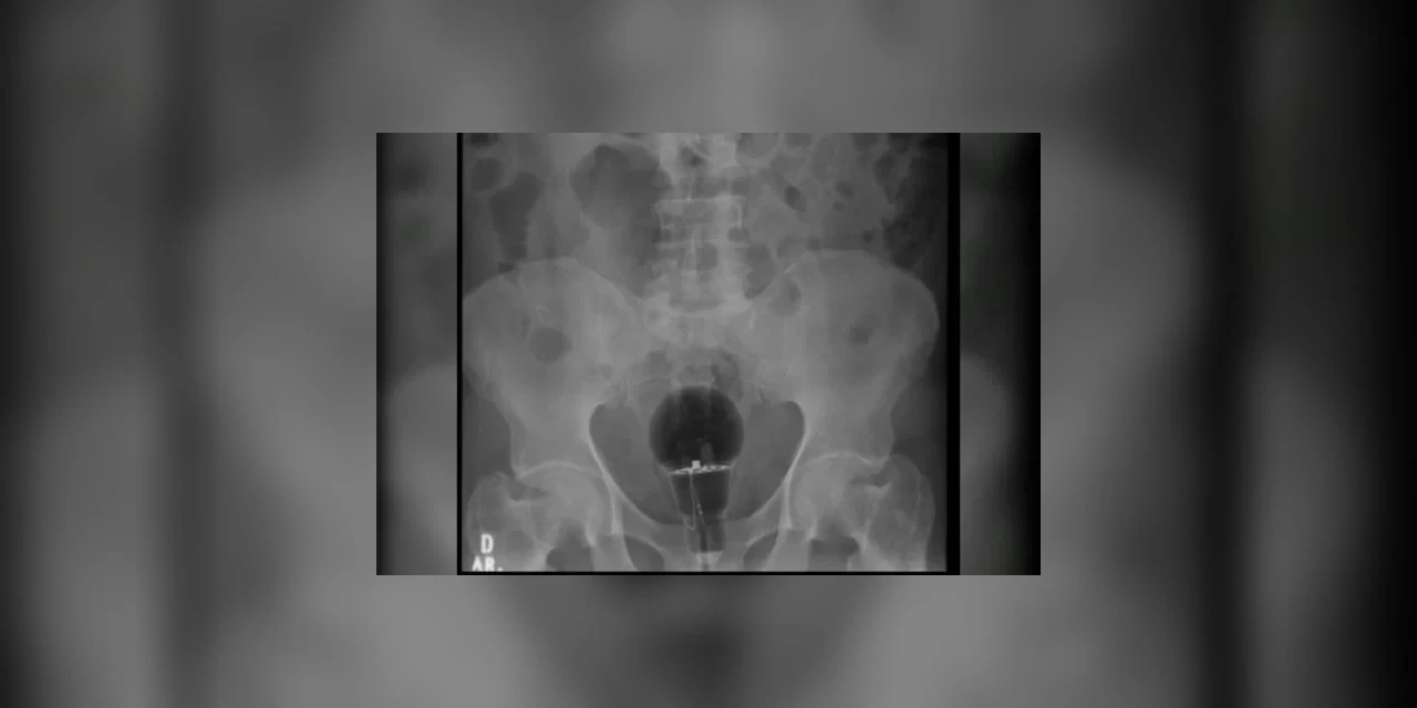 Paciente passa por procedimento para retirar lâmpada do ânus