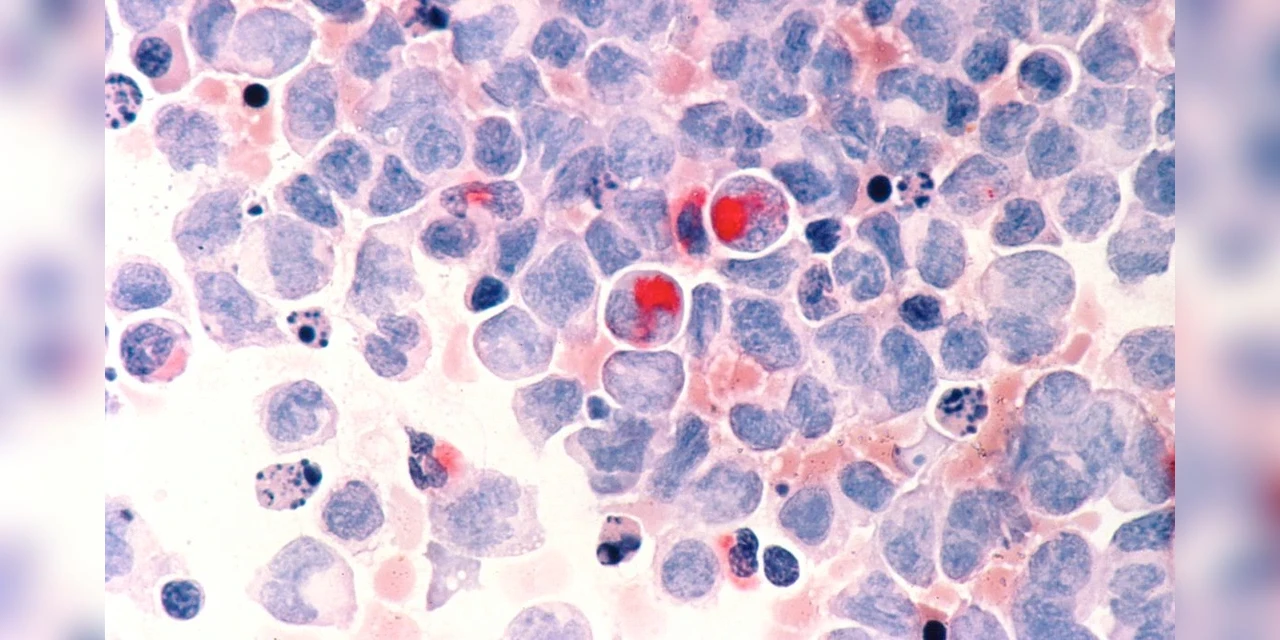 SUS estuda adoção de tratamento promissor contra câncer