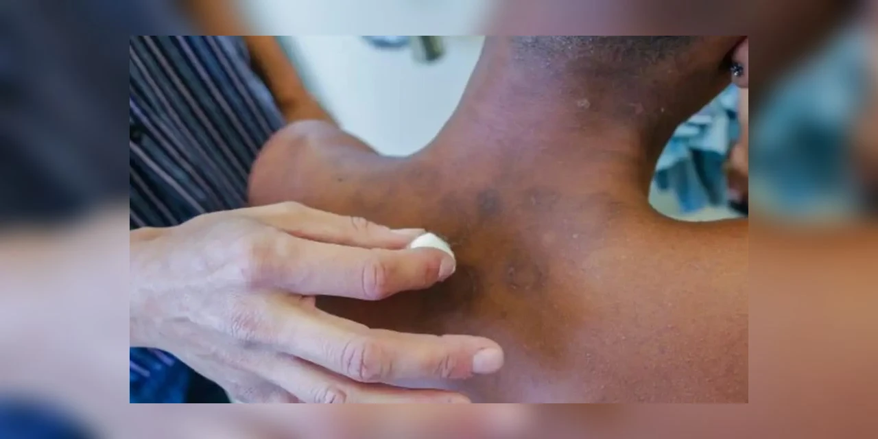 Novos casos de hanseníase aumentaram 5% de janeiro a novembro de 2023