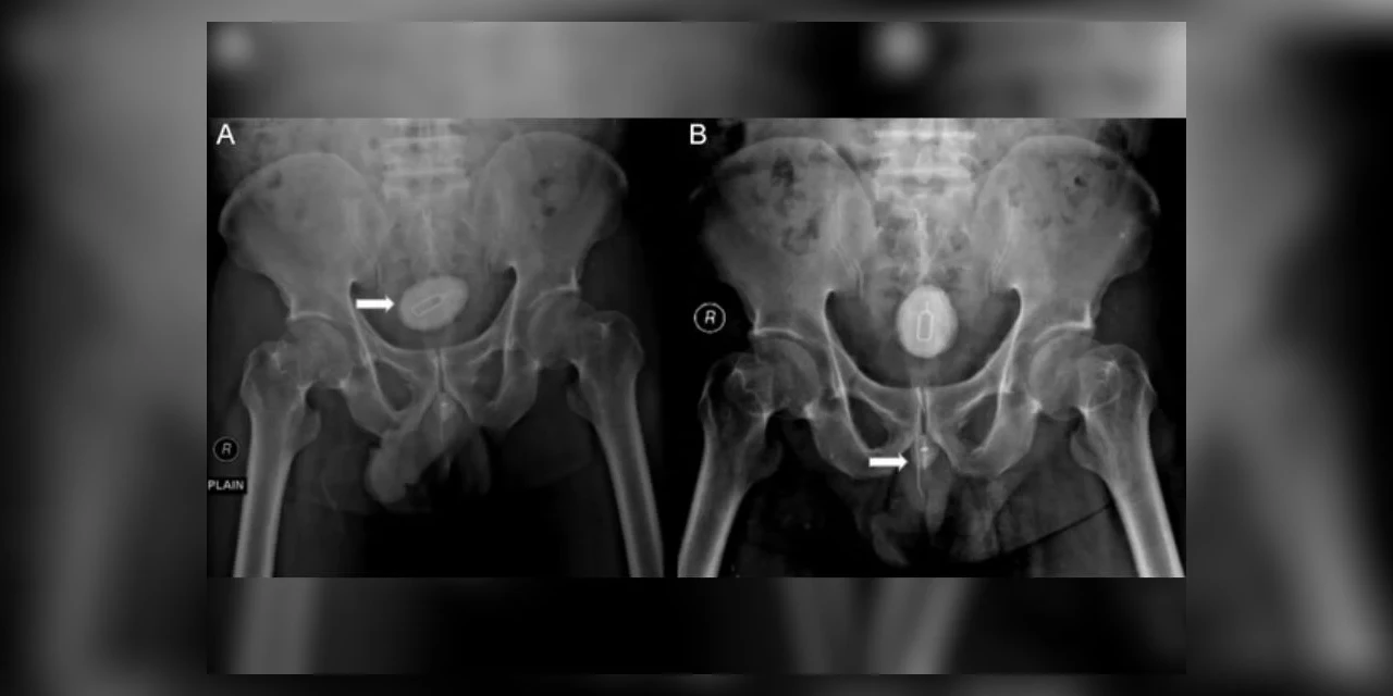 Homem passa por cirurgia após enfiar chave para retirar chip no pênis