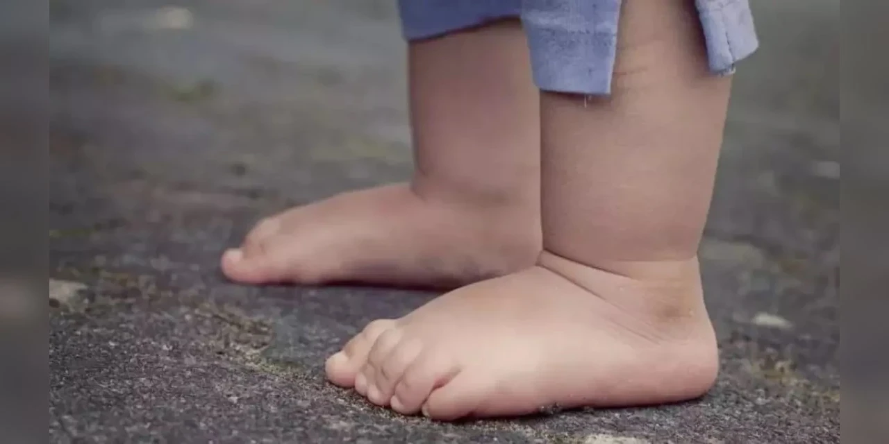 Criança de 1 ano bebe soda cáustica e mãe é presa por abandono de incapaz