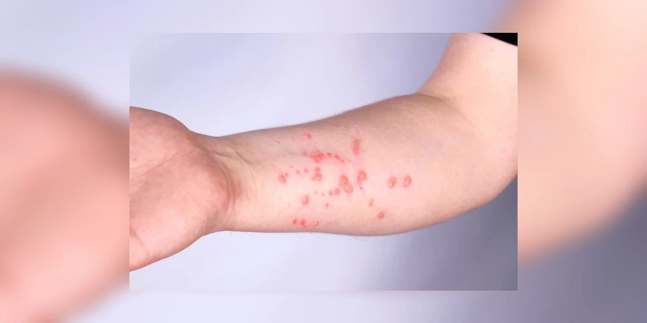 Brasil supera marca de mil casos de mpox em 2024