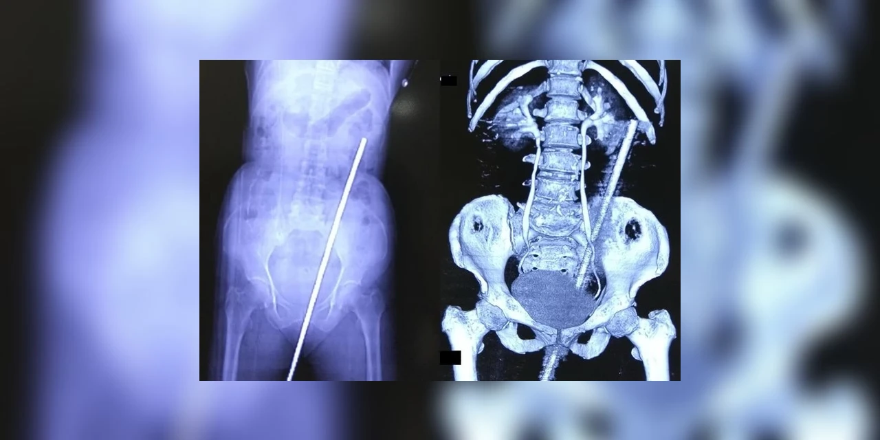 Mulher fica empalada em ferro de 60 cm após cair em pasto