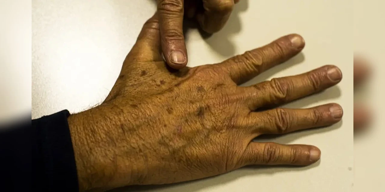 Câncer de pele gera R$ 4,6 mi em custos hospitalares em quase 2 anos