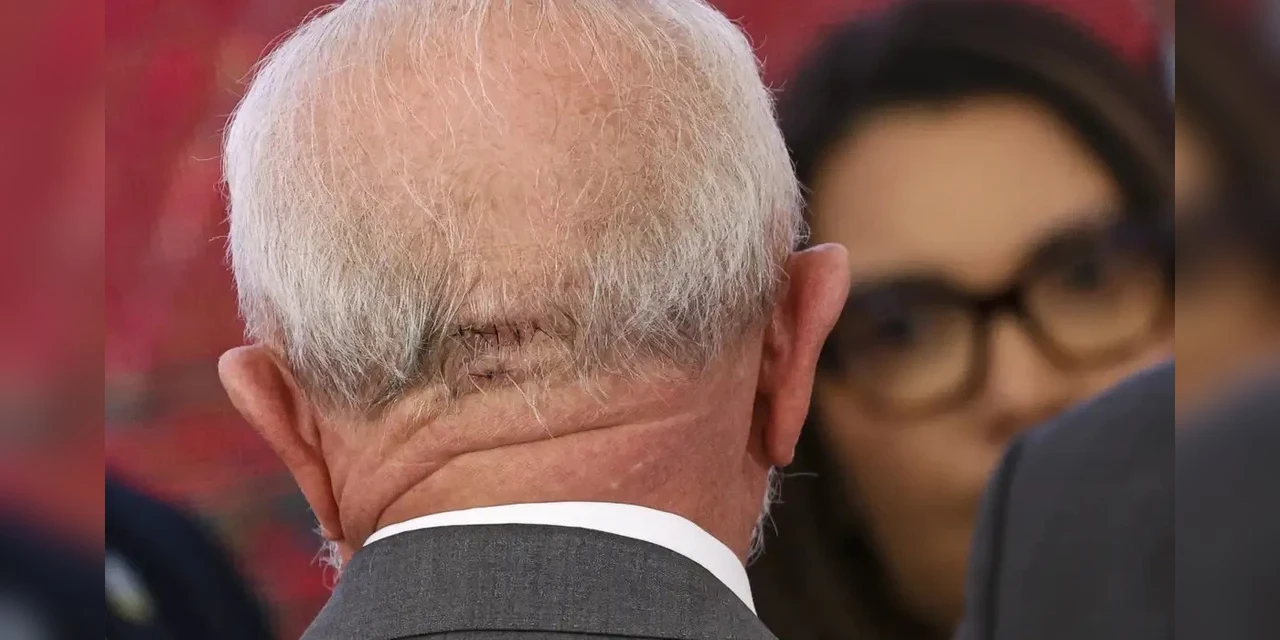 Lula fará novo procedimento médico nesta quinta