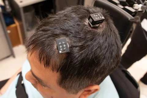 Homem tetraplégico sente e controla outra pessoa com implante cerebral e IA