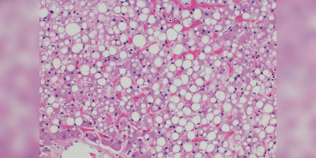 Gordura no fígado cresce entre brasileiros e preocupa especialistas: mudanças no estilo de vida são essenciais para reverter quadro