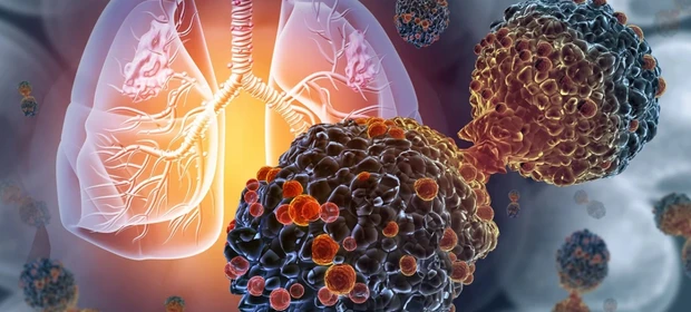Entenda como irá funcionar a primeira vacina contra câncer de pulmão 