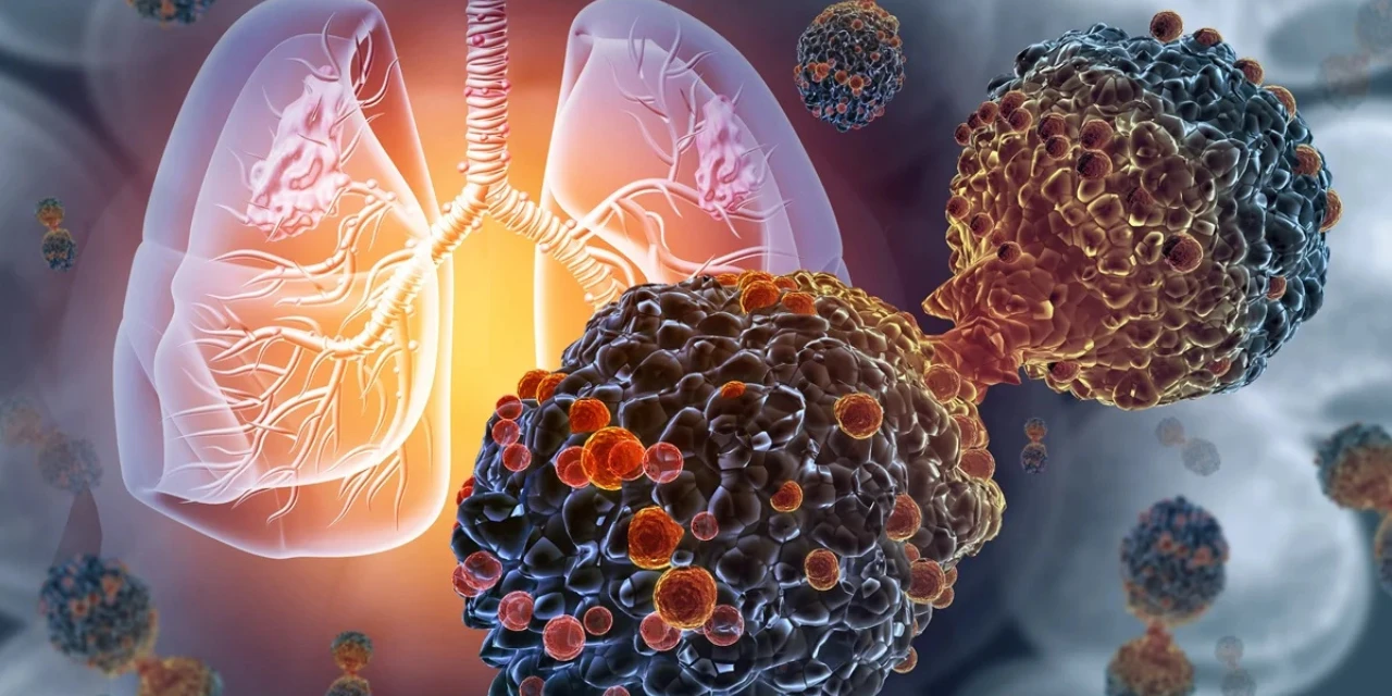 Entenda como irá funcionar a primeira vacina contra câncer de pulmão 