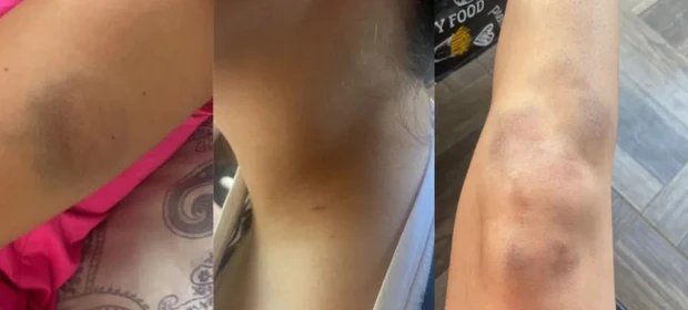 Laudo mostra que "Calvo do Campari" agrediu namorada de mais de 11 vezes