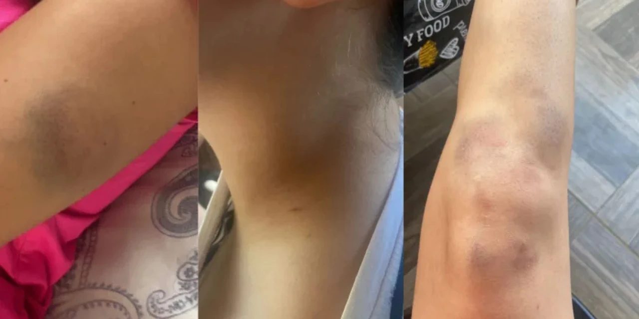 Laudo mostra que "Calvo do Campari" agrediu namorada de mais de 11 vezes